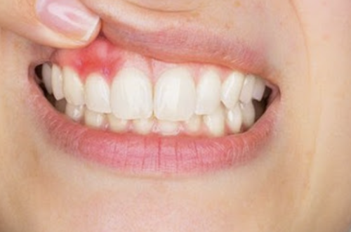 Cara Menghilangkan Bau Mulut Karena Gusi Bengkak