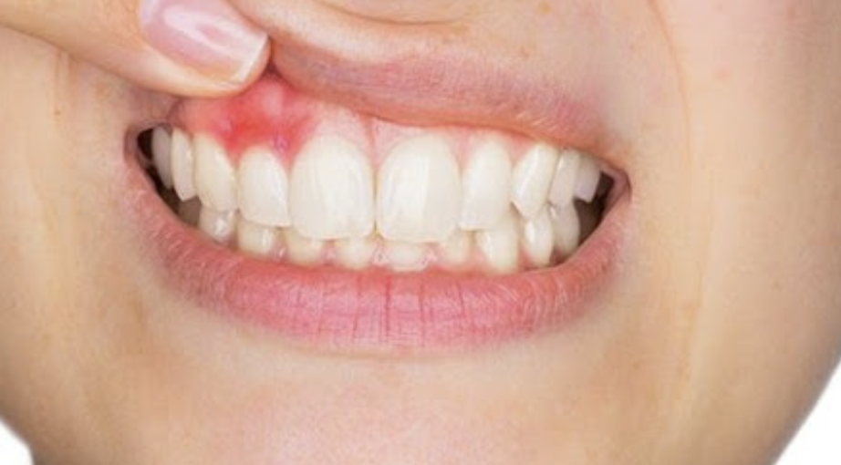 Cara Menghilangkan Bau Mulut Karena Gusi Bengkak